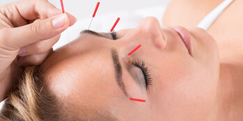 Acupuncture-Treatment